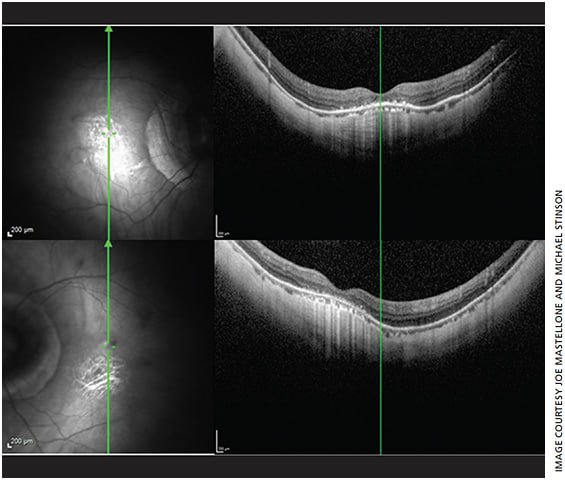 Figure 3. SD-OCT images of the right (top) and left (bottom) maculae exhibiting dome-shaped configuration adjacent to posterior staphyloma and peripapillary atrophy. Presence of choroidal thinning, outer segment atrophy, mild RPE atrophy and foveal exudates are consistent with diagnosis of pathologic myopia. Image taken with a Heidelberg Spectralis.