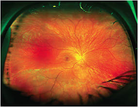 Figure 1. Inferior macula-on rhegmatogenous retinal detachment in a 26-year-old woman with superior visual field defect noted on routine examination.