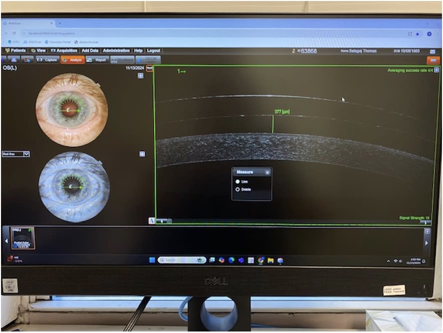 Note this OCT image showing the measurement of scleral lens vault over the central cornea. (Photo courtesy: Dr. Susan A. Resnick)