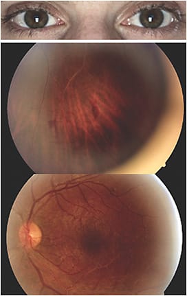 Nerf gun injury OS: Commotio retinae required intervention with the use of steroid.