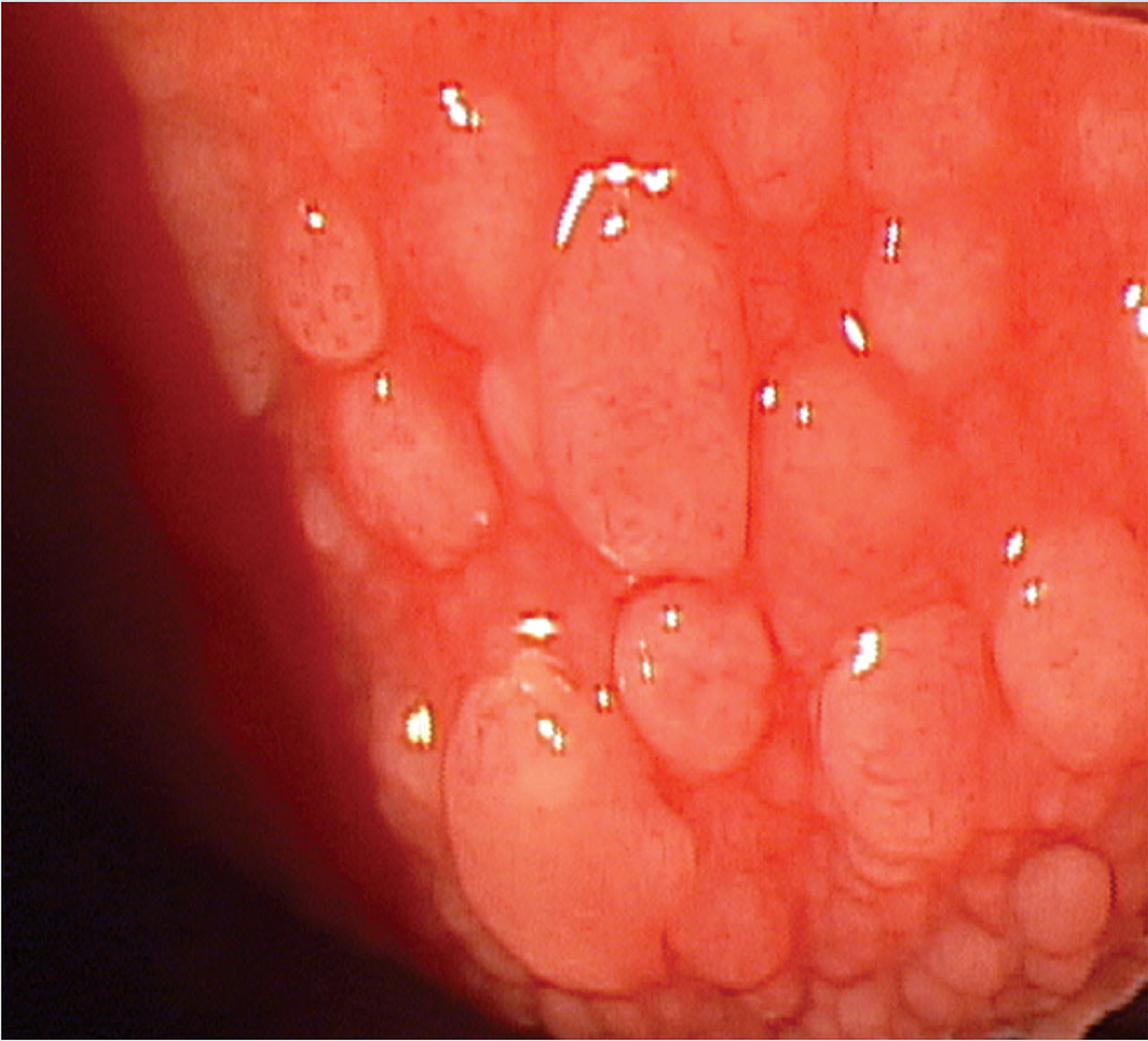 Note the papillary response in this seasonal allergy patient. (Photo courtesy: Alyssa Motter, OD)