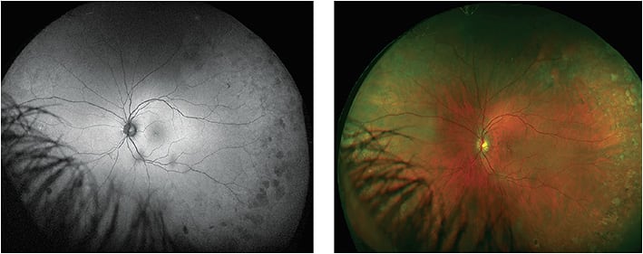 Figure 5. Ultra-widefield autofluorescence (optomap af) revealed darker-than-normal tissue.