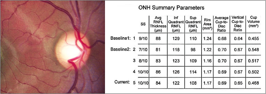 Figure 3. Optic disc CFP and summary of RNFL and optic disc parameters.