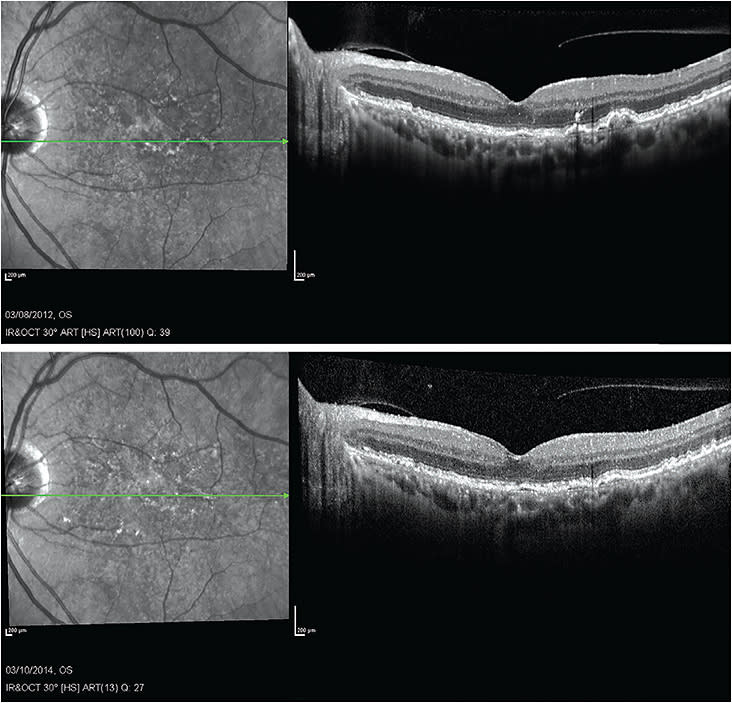 Note the drusen changes in the patient’s left eye over two years. OCT scans can illustrate the importance of prescribed treatment compliance.
Image courtesy of Heidelberg engineering