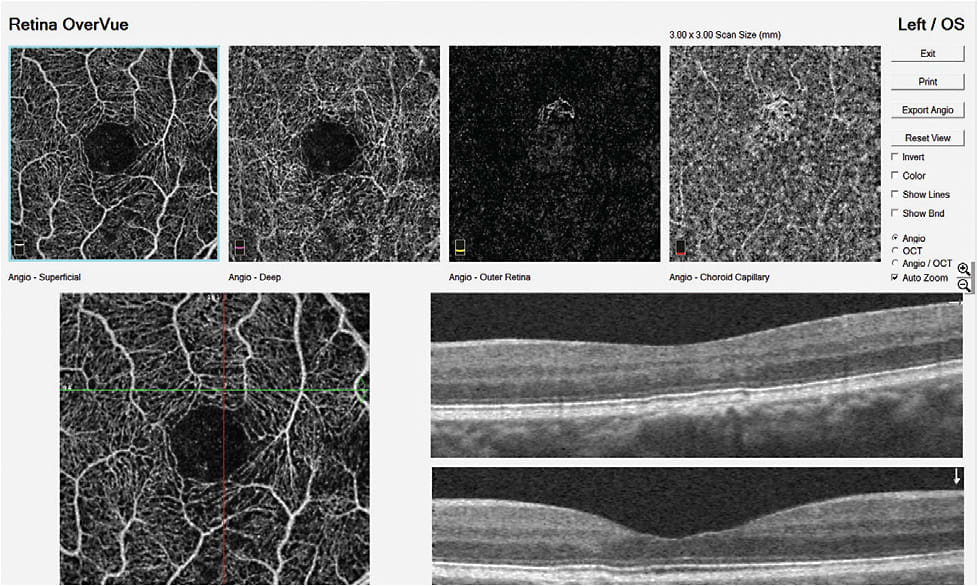 OCTA single-page image report. Dr. Julie Rodman was able to visualize the earliest stages of choroidal neovascular membrane and intervene.
Courtesy of Julie Rodman, O.D.