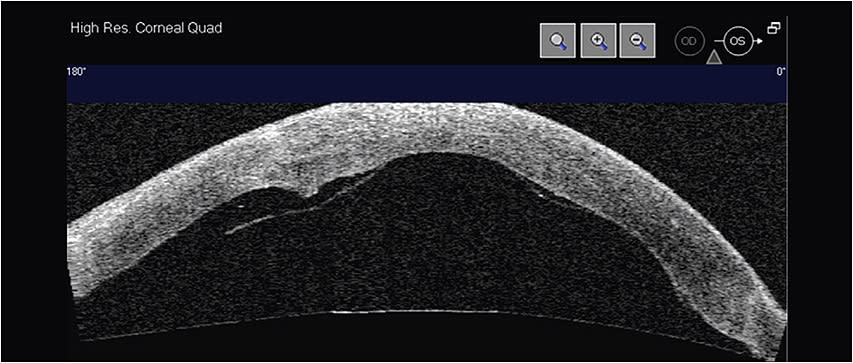 A patient‘s Descemet’s membrane endothelial keratopathy graft, behind a corneal transplant, became detached and was visible with AS-OCT.