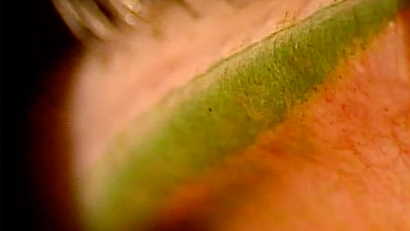 Lid wiper epitheliopathy visible on the everted upper lid—highlights an often overlooked ocular surface finding. (Photo courtesy: Dr. Brujic)