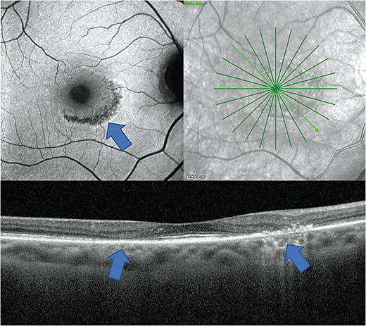Figure 1. FAF (top) showing easily visible ring of hyper-autofluorescence suggestive of RPE disruption. OCT (bottom) showing parafoveal outer nuclear layer atrophy, loss of photoreceptor integrity line and RPE disruption. Image courtesy of Dr. Jessica Haynes.