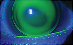Keratoconus as shown by staining
Image courtesy of Dr. Jason Miller.