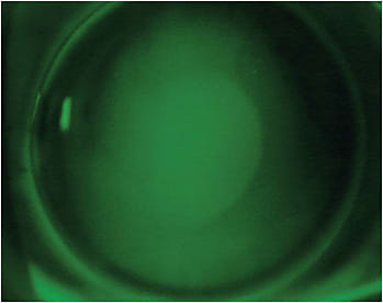 Picture 2: A successful fit with hybrid multifocal contact lenses with proper centration and fit. Image courtesy of Dr. Jason Miller