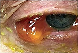 Allergic reaction to a prescribed topical glaucoma medication causing severe conjunctival edema with conjunctival prolapse over the lid margin.
Courtesy of Josh Johnston, O.D..