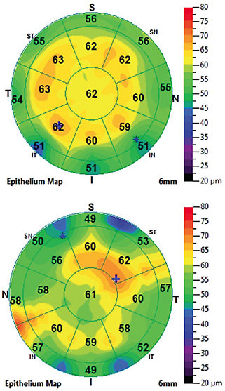 Note the areas of increased epithelial thickness, due to stromal scars from RK, in the anterior segment OCT images above. Image courtesy of Dr. Mile Brujic.