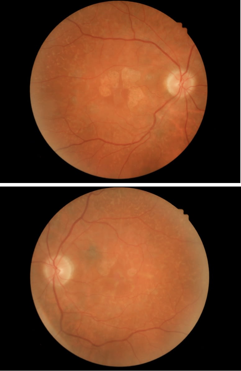 This patient’s OCT showed large areas of atrophy, which matches the areas of hypoFAF. It also revealed deposition anterior to the RPE that is unlike drusen—another clue that this was an AMD masquerader. (Photo courtesy: Dr. Legge)