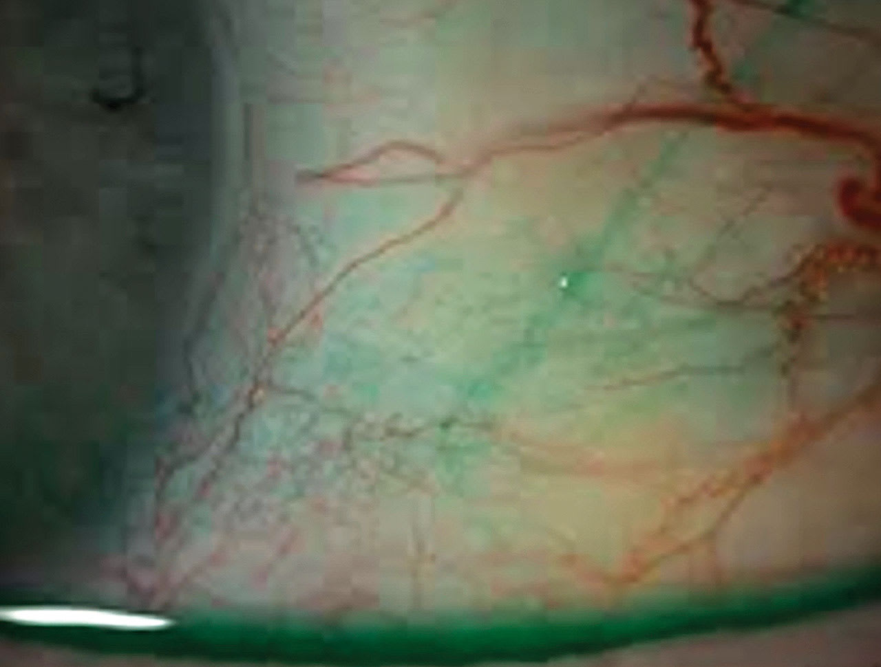 Note the ocular surface staining with lissamine green. (Photo courtesy: Susan A. Resnick, OD, FAAO)