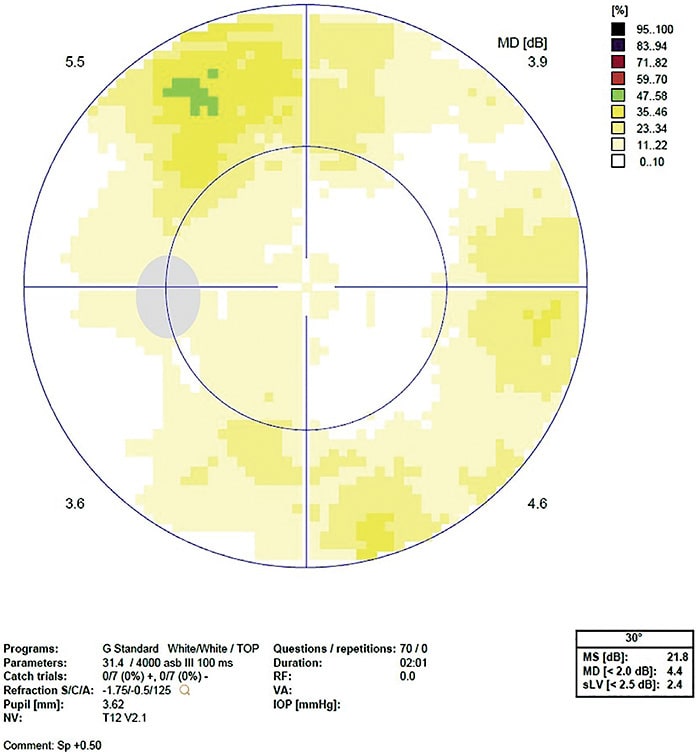 Note the superior and inferior arcuates OS in this glaucoma patient’s VF.
Image courtesy of Dr. Michael J. Cymbor