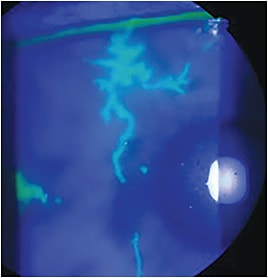 HSV-1 Dendritic epithelial lesions.