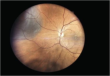 Note the suspicious mass via the iCare EIDON, from CenterVue.Image courtesy of Dr. Carl Blassingame.