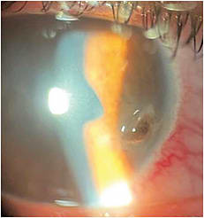 Anterior segment photo of corneal laceration with perforation and iris prolapse.