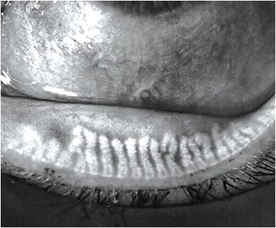 Showing patients images of their meibomian glands makes an impression. Image courtesy of Dr. Damon Dierker.