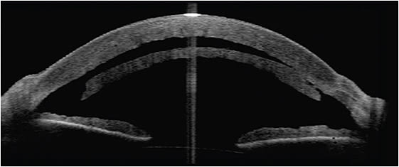 Gross detachment of a graft in a patient who had a previous Descemet’s stripping automated endothelial keratoplasty, via AS-OCT.