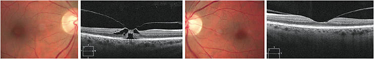 Figure 5. Left panels: CFP and representative horizontal cross-section of the right eye (20/60). Note the remaining vitreous attachment (traction) and cystic spaces. Right panels: CFP and representative horizontal cross-section of the left eye. Note the remaining vitreo-macular attachment (adhesion) without distortion of macular anatomy. The left eye is 20/20. Images originally appeared in Optometry Times, December 2013.