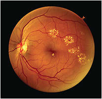 IMAGE: Diabetic retinopathy; photos taken through undilated pupil.