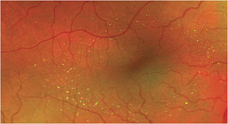 Note the crystalline retinopathy in a 64 year-old female who has a history of using the oral tanning agent canthaxanthin for five years.
Photo courtesy of Sherrol Reynolds, O.D., F.A.A.O.