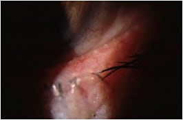 Figure 7. Ocular rosacea and inspissated glands visible upon slit lamp examination.
