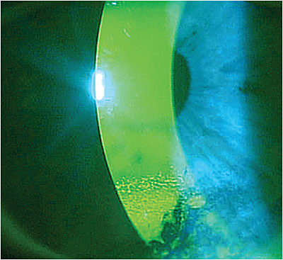 Inferior corneal staining not encroaching the visual axis: Level 2
Image courtesy of Mile Brujic, O.D.