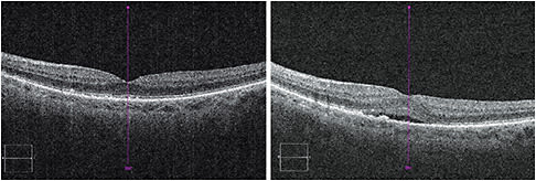 Subretinal fluid in a patient whose CS dropped three steps. Image courtesy of Dr. Mark W. Roark.
