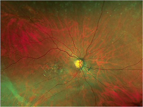 Dry AMD diagnosis and management is in the O.D.’s wheelhouse. Image courtesy of Dr. Mark Roark.