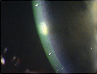 Slit lamp exam revealed a corneal ulcer OD.
Courtesy of Jason R. Miller, O.D., M.B.A.