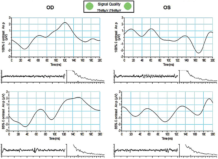 Figure 2. Reduced PERG in an AMD patient. Images courtesy of Dr. Michael Cymbor.