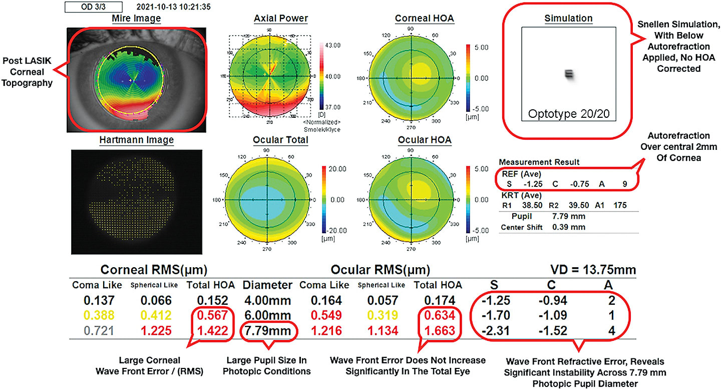 Figure 1. Aberrometry reading of patient showing poor night vision, significant eye strain with habitual eyeglasses in photopic conditions, and obvious ghosting of text on street signs.Image courtesy of Dr. Brandon.