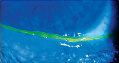 Figure 8. Fluorescein reveals eyelid notching and irregularity due to chronic tear film instability.