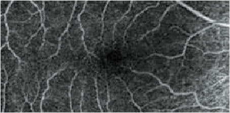 OCT angiography image of a patient with non-exudative AMD.
Courtesy of Dr. Jessica Steen