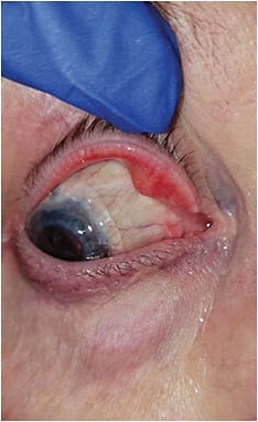 Scleral lens placed over a 5-year-old tube.Photo courtesy of Dr. Christine Wells Sindt.