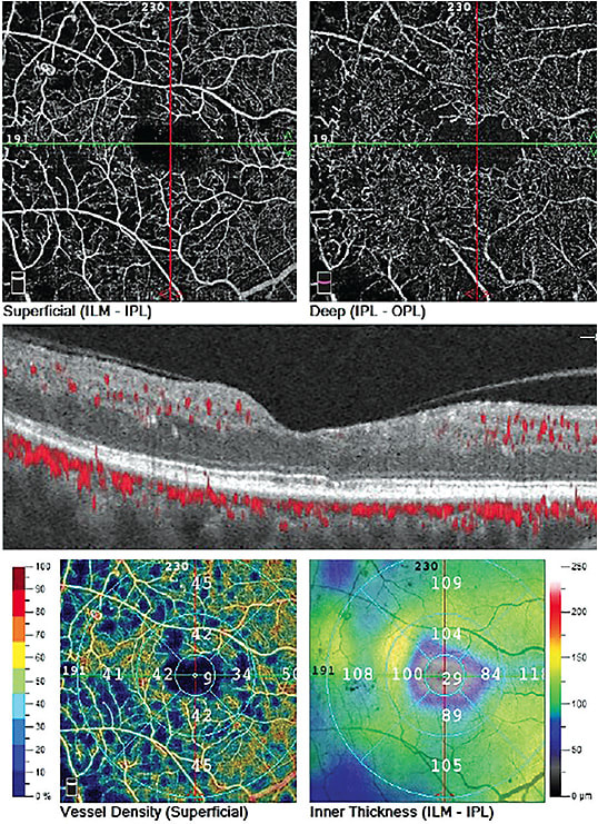 Figure 4. OCT-A vessel density map in an uncontrolled diabetic shows dark areas of nonperfusion with an enlarged FAZ. Images courtesy of Dr. Michael Cymbor.