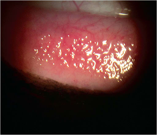 Papillary conjunctivitis can be associated with bacterial and/or allergic conjunctivitis. 
Photo courtesy of Vin T. Dang,O.D., F.A.A.O.