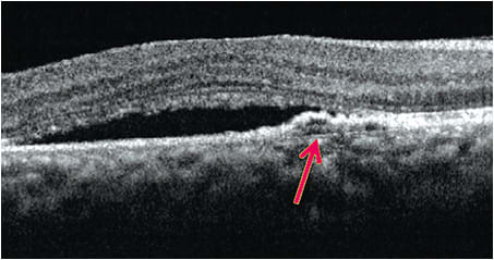 Double-layer sign is indicative of a choroidal neovascular membrane in a patient with central serous chorioretinopathy.
Courtesy of Dr. Jessica Steen