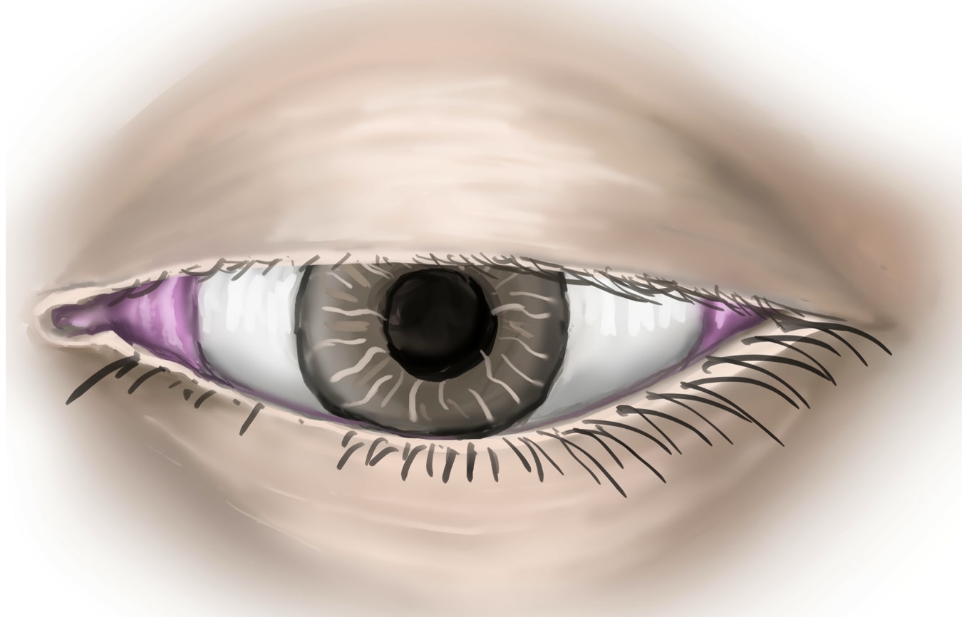 Lid ptosis can portend fatal conditions.