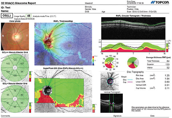 IMAGE: Note the 3D-wide glaucoma report.