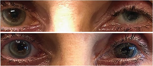 Note this patient’s left eye before (top) and after (bottom) prosthetic CL use.Photos courtesy of Dr. Resnick