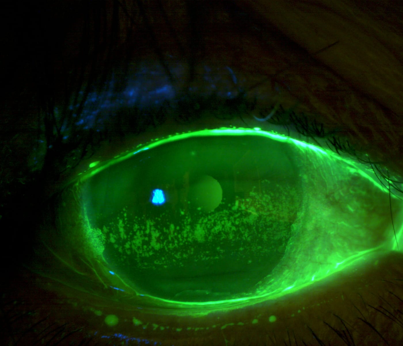 Note this persistent superficial punctate keratitis in Stage I neurotrophic keratopathy. (Photo credit: Dr. Kataria)