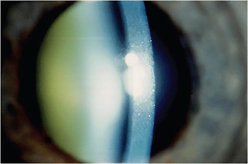 Treating cataracts goes beyond its clinical presentation (shown above). It’s about making patients comfortable. 
Image courtesy of  Dr. Emilio Balius