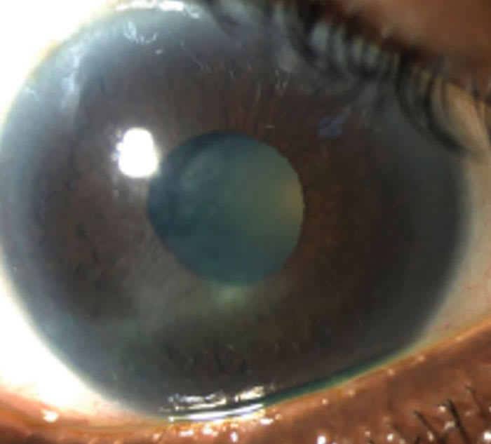 Neurotrophic keratitis in a 75-year-old woman with poorly controlled diabetes. Contact lens fitting is contraindicated. (Photo courtesy: Dr. Resnick)