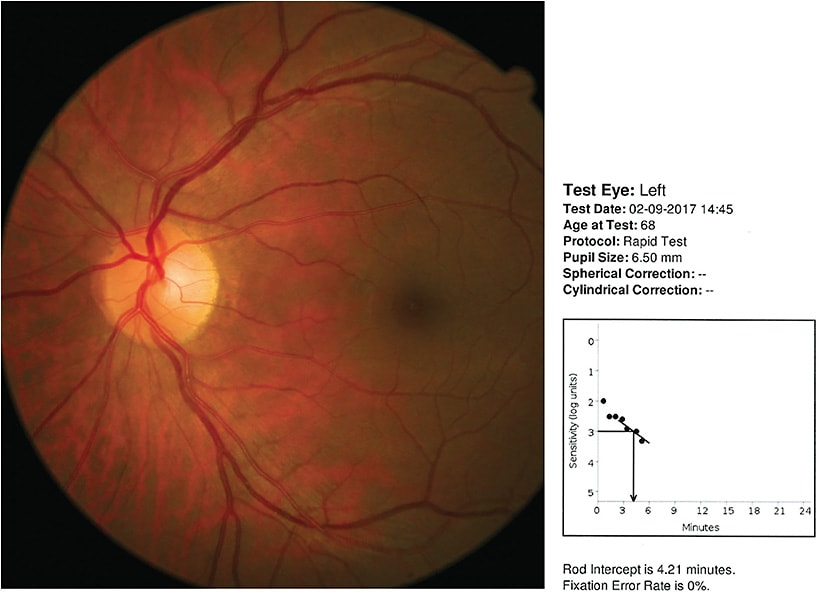 Figure 2. Left color fundus photograph showing absence of drusen, or pigmentary abnormalities. Right panel: rod-mediated dark adaptation results indicating normal dark adaptation. If the rod-intercept time had been greater than 6.1 minutes, further testing would be indicated along with closer scrutiny. 
All images courtesy of Leo Semes, O.D., F.A.A.O.