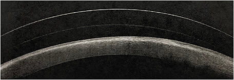 Note the scleral lens vaulting the cornea of our patient with SND. 
Photo courtesy of Savannah B. Long, O.D.