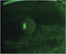 Let’s look closely for ocular surface dryness signs via sodium fluorescein, with a Wratten filter. Image courtesy of Dr. Jason Miller.