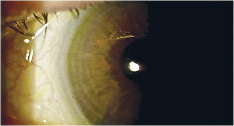 Corneal neovascularization, secondary to contact lens wear complications
Image courtesy of Dr. Wroten